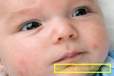 Причини за бели мозолчиња на лицето на новороденче